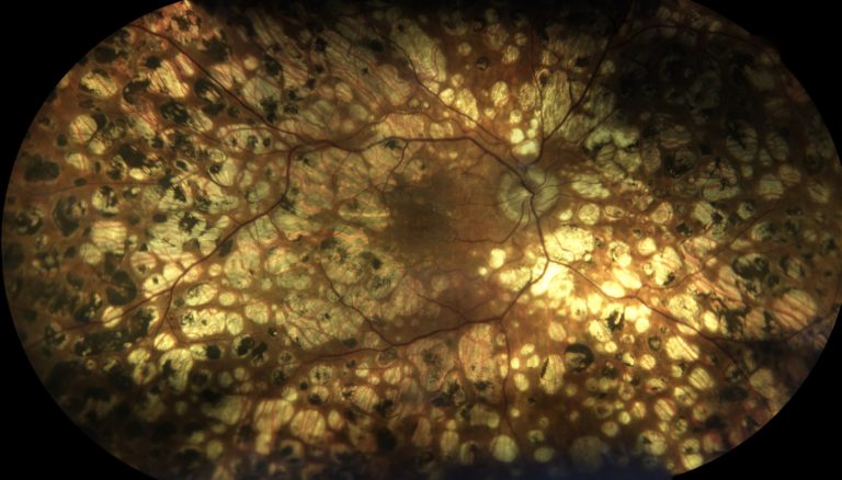 Panretinal_photocoagulation
